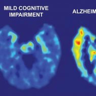 Des chercheurs d'Université de San Francisco ont créé une IA qui peut détecter les premiers signes d'Alzheimer avec 6 ans d'avance sur un diagnostic clinique